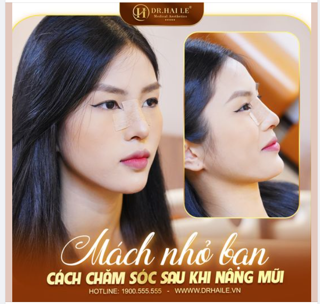 Mách nhỏ bạn cách chăm sóc sau nâng mũi