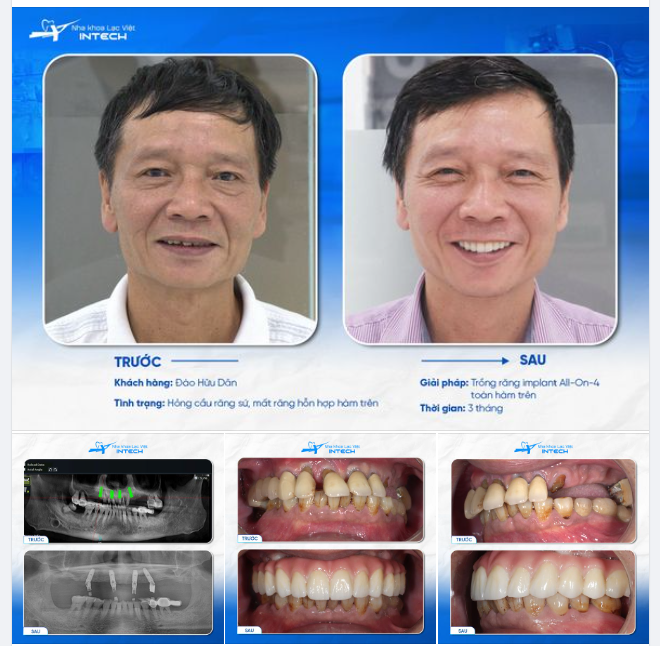CẦU RĂNG SỨ HỎNG, U70 "THOÁT" BIẾN CHỨNG NẶNG NHỜ TÌM ĐÚNG PHƯƠNG PHÁP KHẮC PHỤC