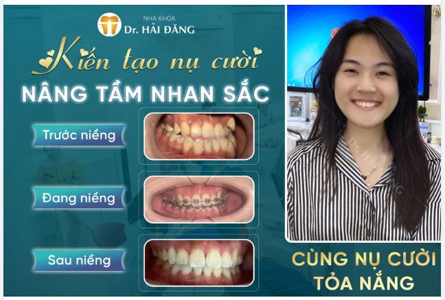 KHÁCH HÀNG: TRẦN THỊ THANH HƯƠNG đến với nha khoa trong tình trạng răng: Khớp cắn ngược, Răng khấp khểnh, Móm
