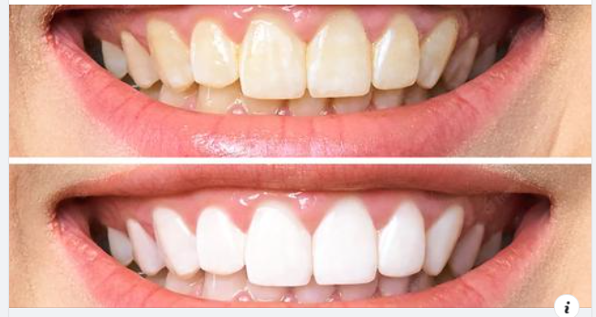 Cách làm trắng răng an toàn và hiệu quả là gì?