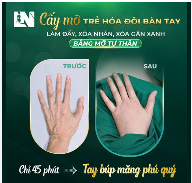 "Lột xác" đôi bàn tay nhăn nheo, gầy gò, đầy gân xanh ở tuổi 40 với "CẤY MỠ TỰ THÂN"
