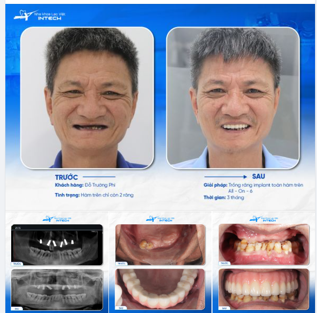 NHỜ CÔNG NGHỆ TRỒNG RĂNG HIỆN ĐẠI, U60 HOÀN THÀNH ƯỚC MƠ CÓ HÀM RĂNG MỚI TRỌN VẸN