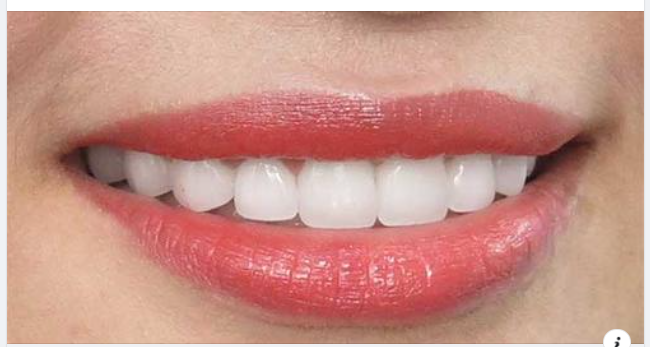 Bọc răng sứ giữ được bao lâu và hướng dẫn chăm sóc sau bọc răng