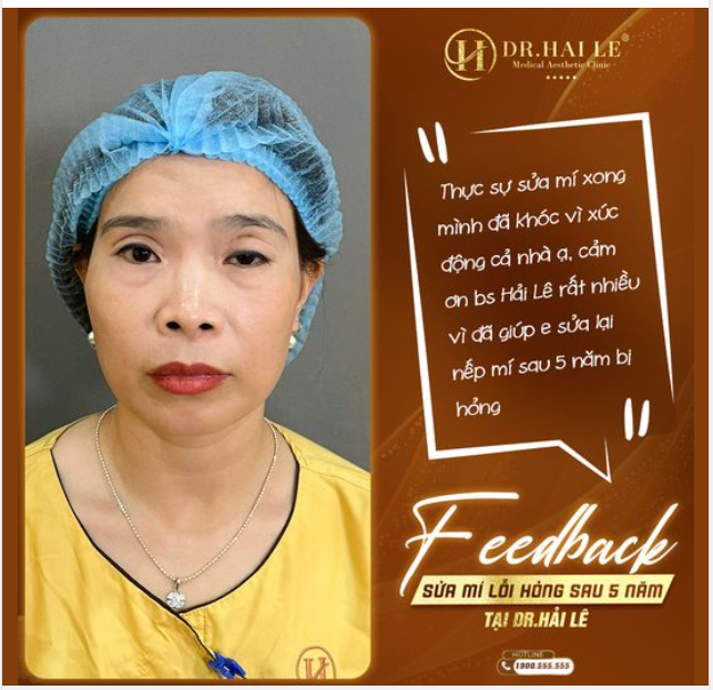  Chị khách chia sẻ sau khi cặp mí lỗi hỏng được sửa thành công tại Dr.Hải Lê.