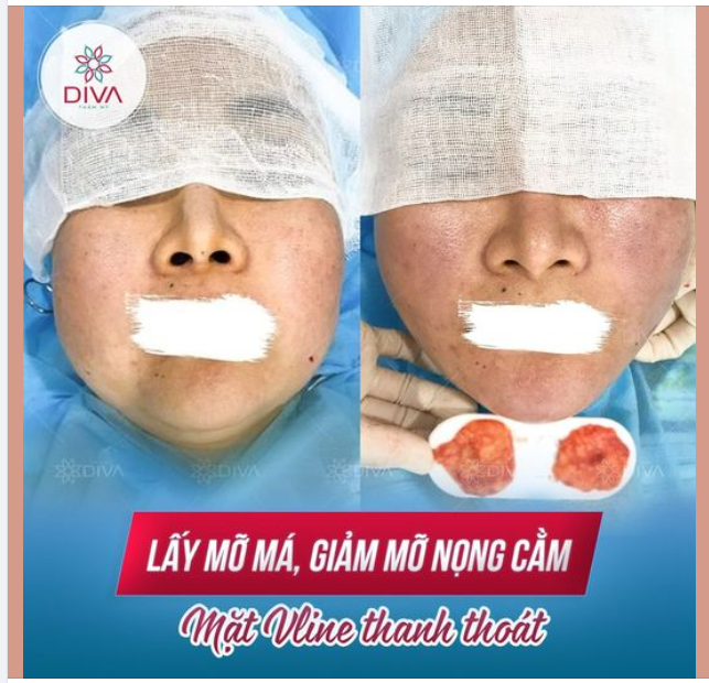 KẾT QUẢ THẨM MỸ SAU LẤY MỠ MÁ, GIẢM MỠ NỌNG CẰM - GƯƠNG MẶT NHẸ NHÀNG, THON GỌN