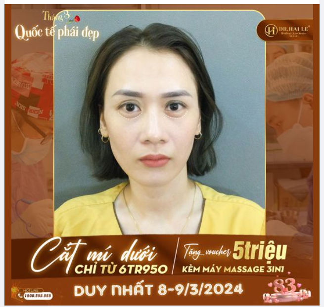 Ưu điểm cắt mí tại Dr Hải Lê
