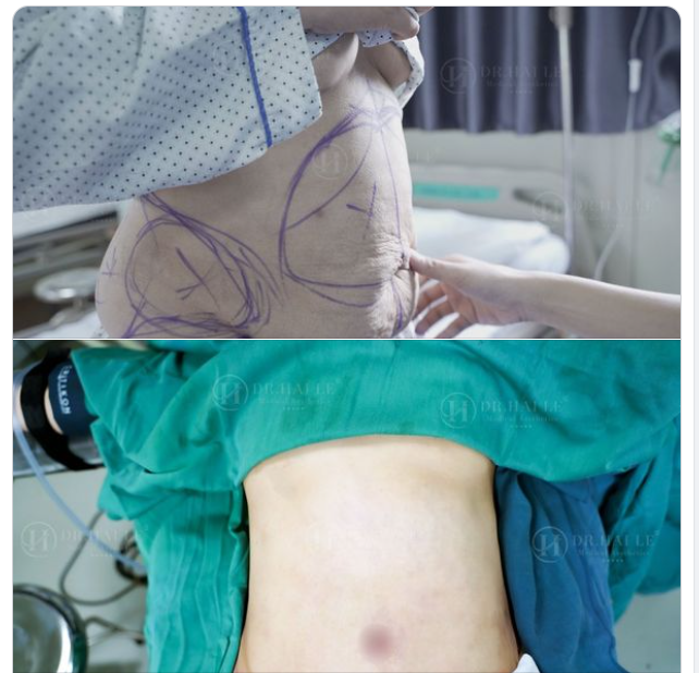 Nỗi lo về “ Mỡ bụng” sẽ được giải quyết khi đến với Dr.Hải Lê.