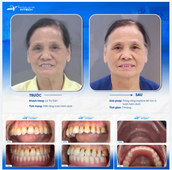 U70 VƯỢT QUA NỖI SỢ TRỒNG RĂNG IMPLANT KHÔNG AN TOÀN NHỜ SỬ DỤNG CÔNG NGHỆ HIỆN ĐẠI