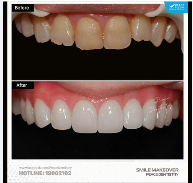 DÁN VENEER CẢI THIỆN MÀU RĂNG - MỘT SỐ LƯU Ý HỮU ÍCH: