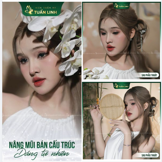 Nâng mũi bán cấu trúc cao sang, trẻ trung, form tự nhiên!