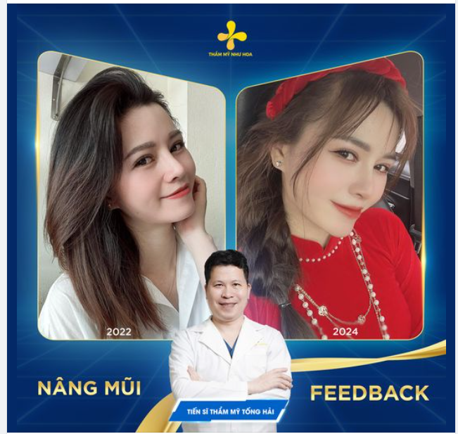 Nâng mũi đẹp, tự nhiên, hợp phong thủy thôi chưa đủ. Còn phải bền, phải ổn định theo năm tháng nữa mới là điều khách hàng thực sự mong muốn.