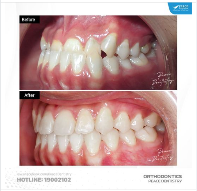 THAY ĐỔI NGỠ NGÀNG SAU KHI NIỀNG RĂNG