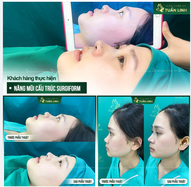 Chỉnh sửa lại mọi dáng mũi xấu, siêu xấu Kỹ thuật nâng mũi độc quyền, tái lập lại cấu trúc mũi mới.