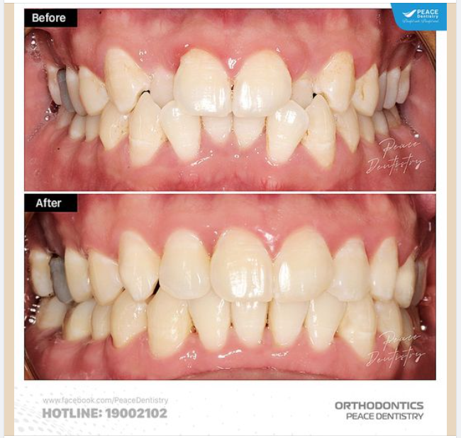 NIỀNG RĂNG TẠO KHOẢNG CHỈNH NHA  KHÔNG NHỔ RĂNG