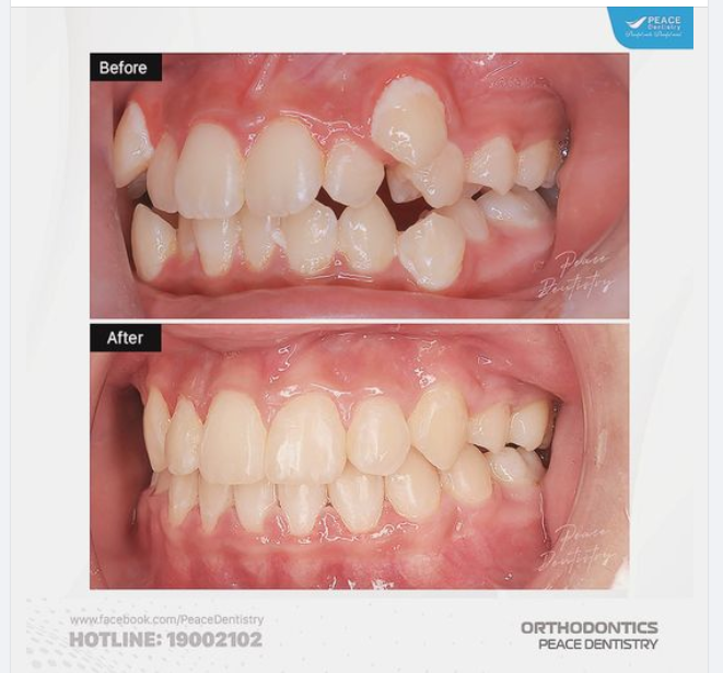 NIỀNG RĂNG KHẤP KHỂNH  4 KỸ THUẬT TẠO KHOẢNG MÀ BÁC SĨ PEACE DENTISTRY THƯỜNG ÁP DỤNG: