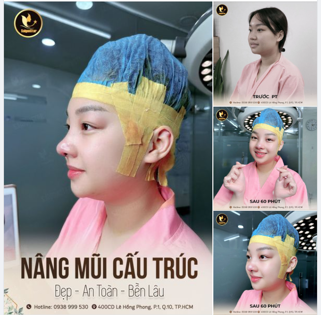 NÂNG MŨI CẤU TRÚC DR. HOẠT