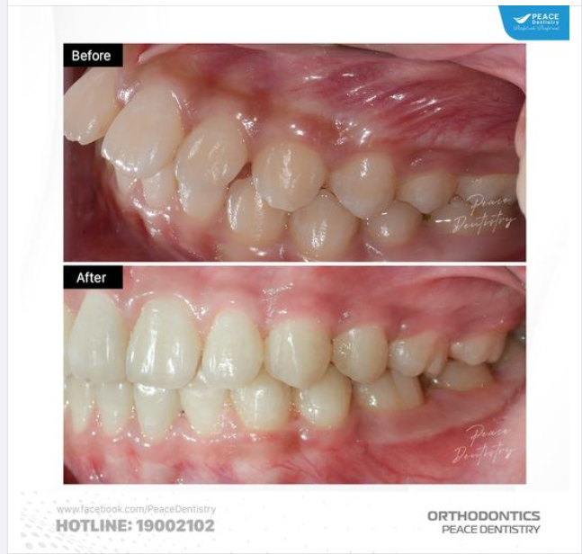 Sau 20 THÁNG NIỀNG RĂNG tại Peace Dentistry, kết quả đạt được vô cùng khích lệ cho cả khách hàng và bác sĩ chỉnh nha trực tiếp điều trị: