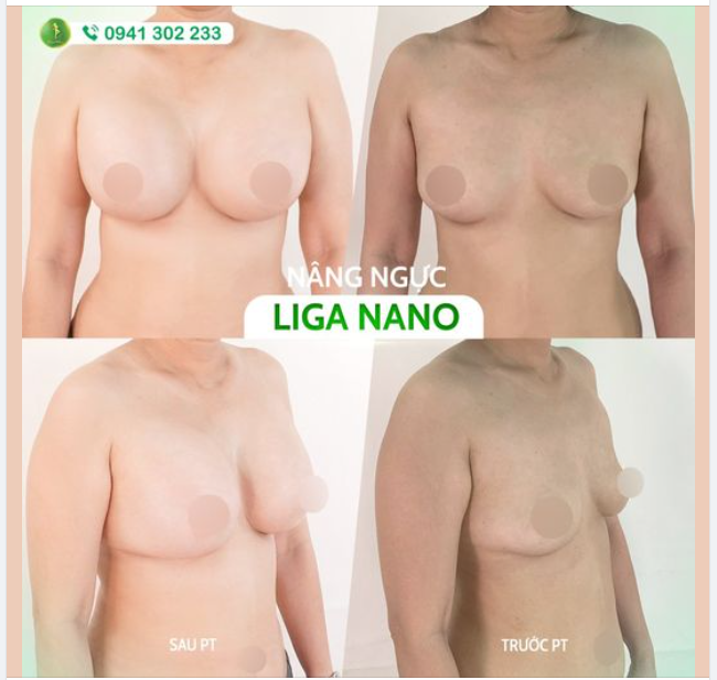 KHÁCH HÀNG FEEDBACK VỀ DỊCH VỤ NÂNG V1 LIGA NANO TẠI SAIGON VENUS