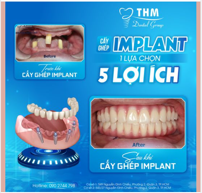 CẤY GHÉP IMPLANT - 1 PHƯƠNG PHÁP, 5 LỢI ÍCH