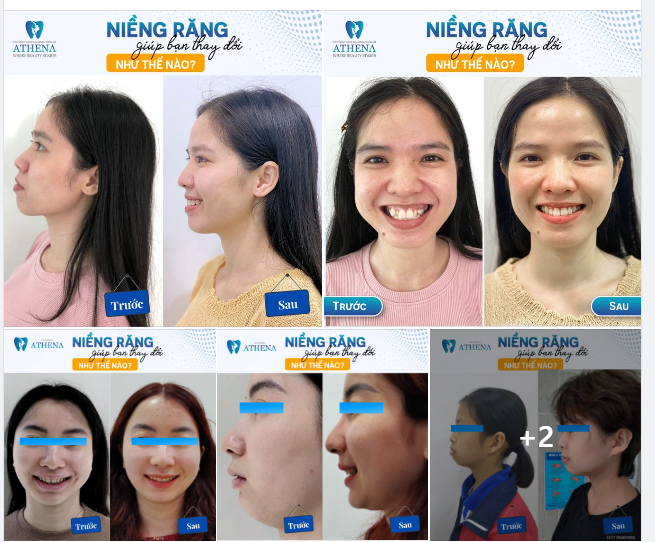 THÁO MẮC CÀI - THOẢI MÁI CƯỜI XINH