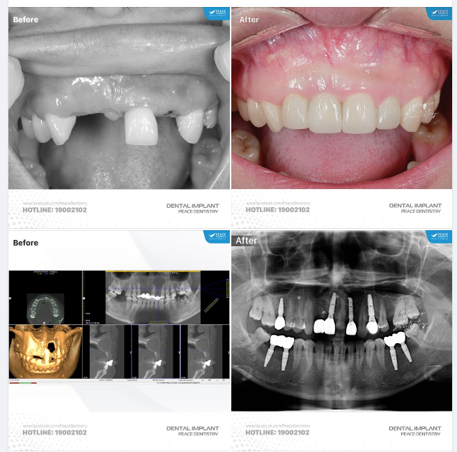 Ca lâm sàng implant có ghép xương, ghép nướu, kết hợp dán veneer răng cửa giúp khôi phục trọn vẹn chức năng ăn nhai và cải thiện thẩm mỹ nụ cười.