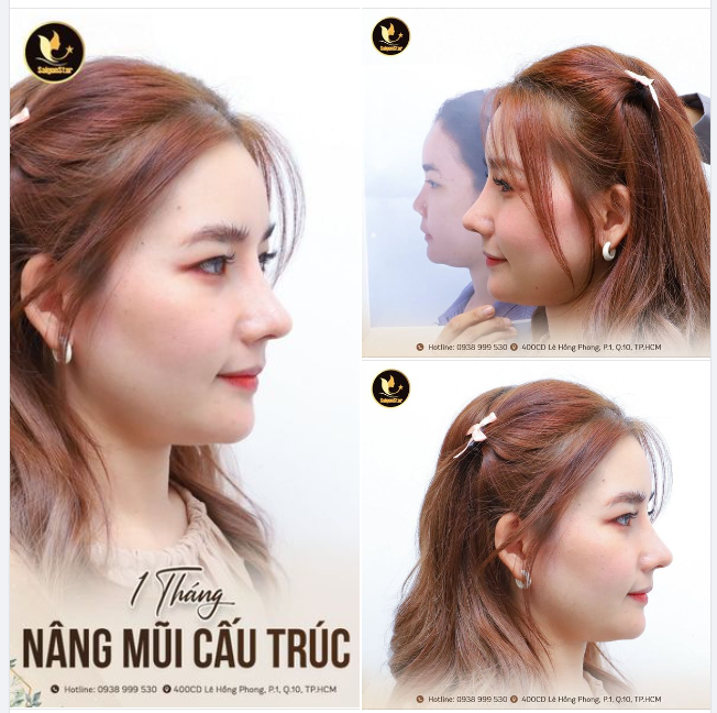 KHOE NHẸ CHIẾC MŨI SIÊU XINH SAU 1 THÁNG TẠI BÁC SĨ HOẠT