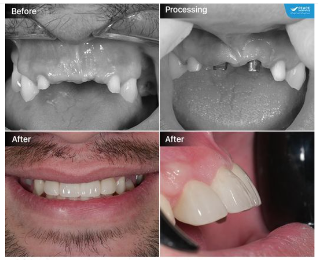 LÀM SAO ĐỂ PHỤC HÌNH TRÊN IMPLANT ĐẠT KẾT QUẢ TỐI ƯU?