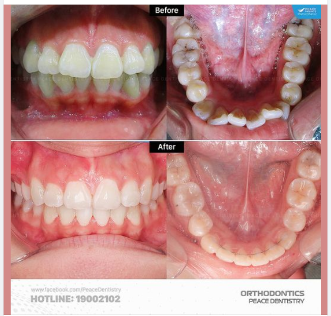 Nâng mũi S line là phương pháp thẩm mỹ giúp thay đổi hình dáng mũi một cách tự nhiên và hiệu quả. Hãy xem ảnh nâng mũi S line để hiểu rõ hơn về quá trình và kết quả của phương pháp này.