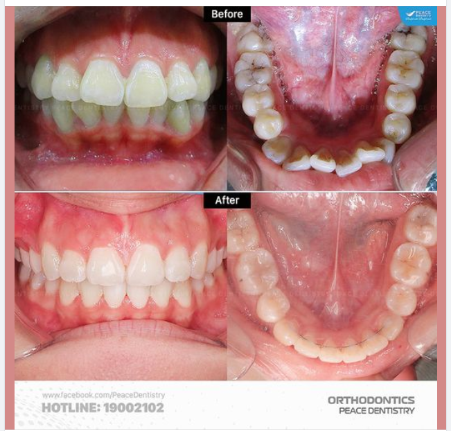NIỀNG RĂNG HÔ: GIẢI ĐÁP NHANH 7 CÂU HỎI PHỔ BIẾN