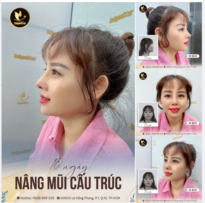 “NHẢ VÍA” MŨI ĐẸP 10 NGÀY CHO CHỊ EM