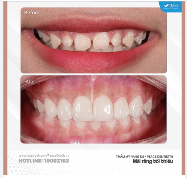 CA LÂM SÀNG CẮT NƯỚU  DÁN VENEER VÙNG RĂNG TRƯỚC GIÚP NÂNG CAO THẨM MỸ NỤ CƯỜI