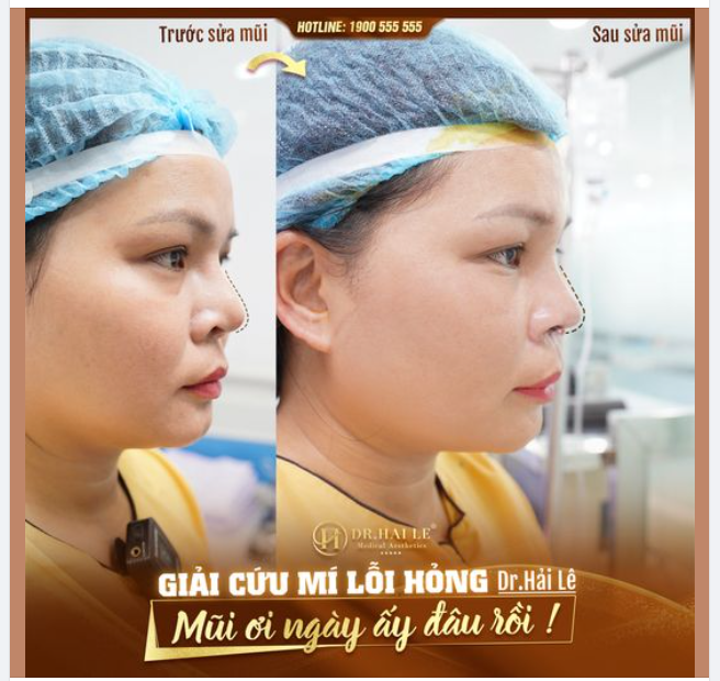 Không ít chị em đã gặp phải tình trạng mũi lỗi hỏng khi đang trên con đường cải thiện nhan sắc.