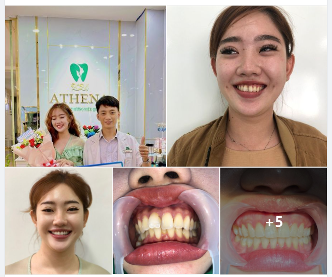 TỪ CHỐI QUÁ KHỨ NGAY SAU KHI THÁO MẮC CÀI TẠI ATHENA