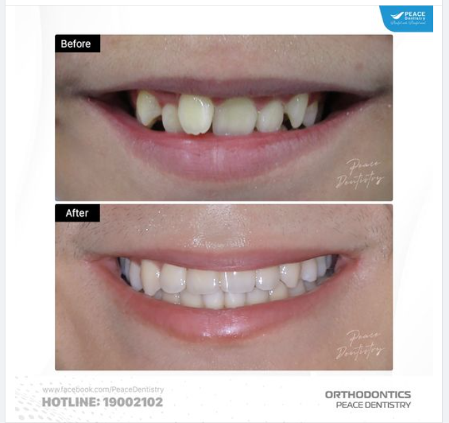 NIỀNG RĂNG CHEN CHÚC: CÀNG SỚM THÌ CÀNG CÓ LỢI