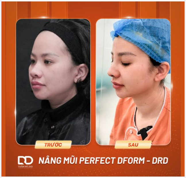 KHÁC BIỆT ĐẾN TỪ GÓC NGHIÊNG. NÂNG MŨI PERFECT DFORM THAY ĐỔI NGAY SAU 45 PHÚT