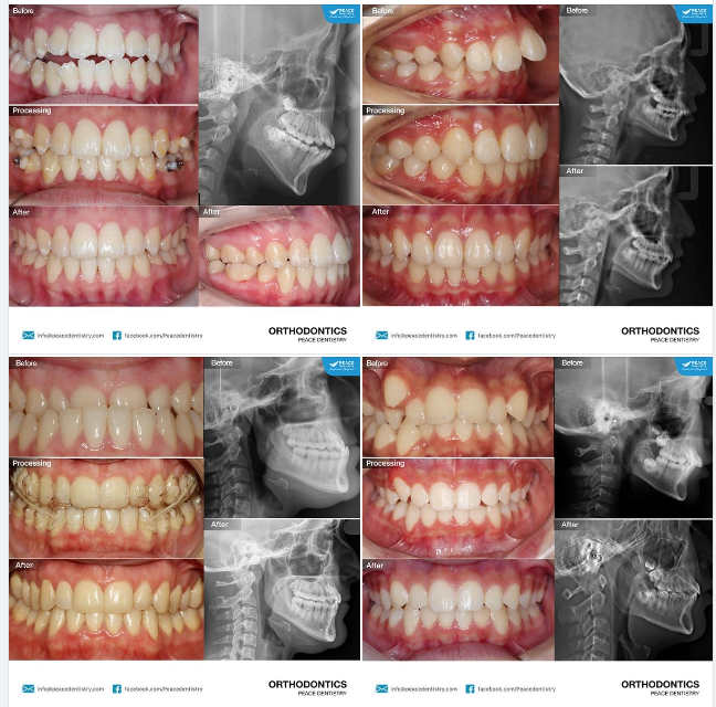 GIẢI TOẢ 5 NỖI LO KHIẾN BẠN NGẦN NGẠI QUYẾT ĐỊNH NIỀNG RĂNG INVISALIGN