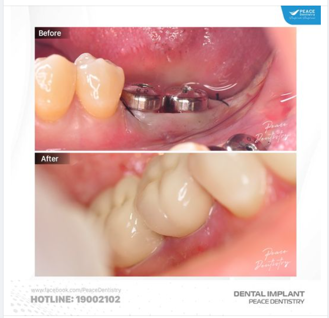 VÌ SAO IMPLANT LÀ LỰA CHỌN TUYỆT VỜI KHI MẤT RĂNG?