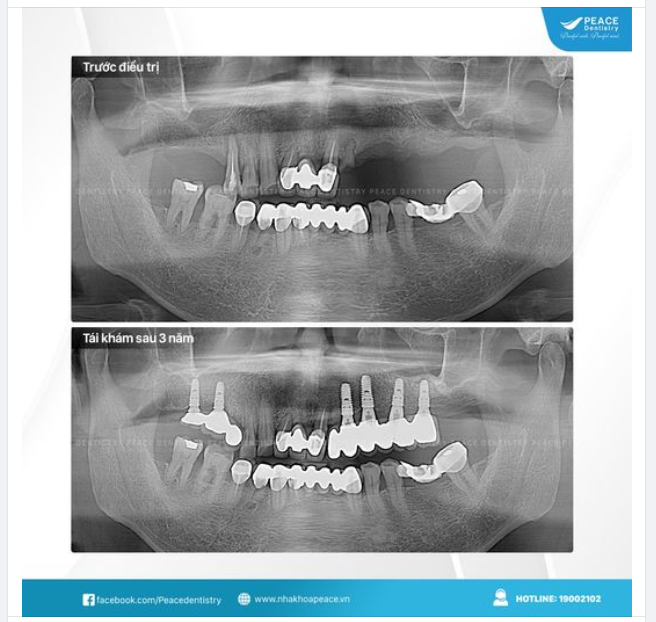 TÁI KHÁM SAU 3 NĂM TRỒNG RĂNG IMPLANT TẠI PEACE DENTISTRY