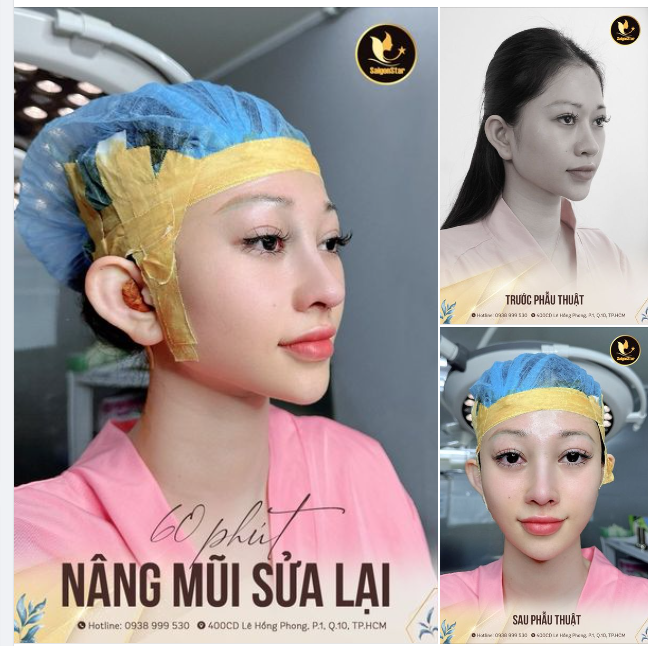 60 PHÚT NÂNG MŨI SỬA LẠI