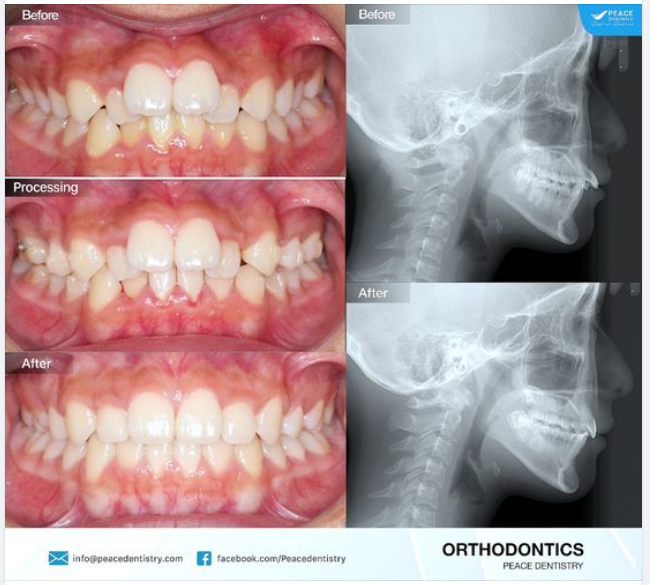 Ca lâm sàng invisalign cho răng chen chúc nặng, răng cửa mọc chìa với thời gian hoàn thành 24 tháng.