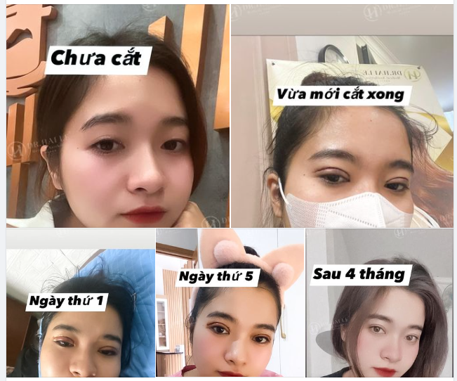 Sau 4 tháng cắt mí tại Dr.Hải Lê trông sẽ như thế nào, check....