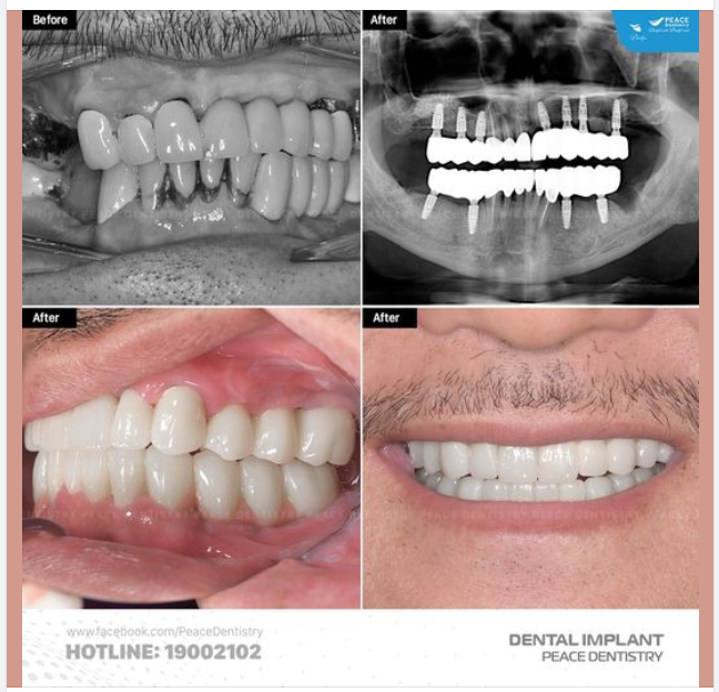" Cấy trụ implant rồi, nhưng chưa thể quay về Việt Nam đúng hẹn để gắn răng sứ mà để 1, 2... năm sau mới thực hiện thì có được hay không? Có ảnh hưởng gì đến trụ Implant?"
