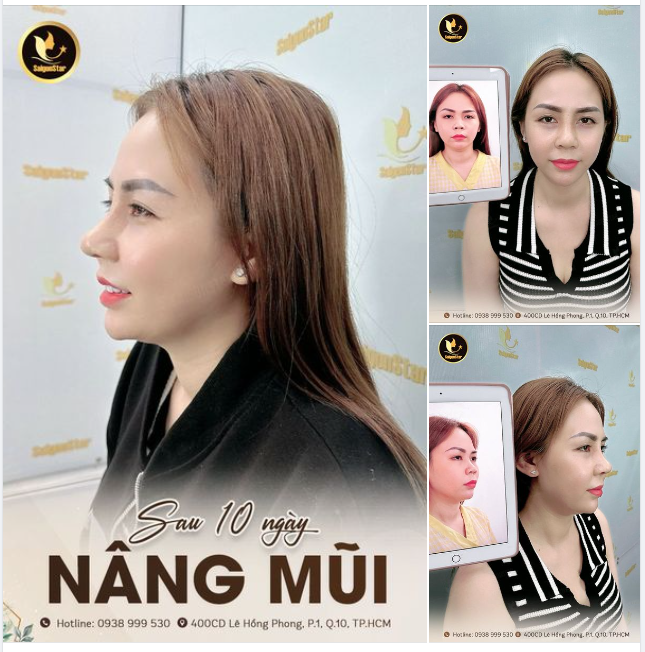 SAU 10 NGÀY NÂNG MŨI CẤU TRÚC