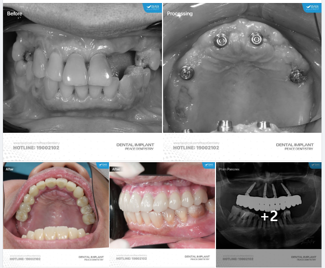 ALL-ON-4 IMPLANT PHỤC HÌNH TỨC THÌ SAU 2 TUẦN