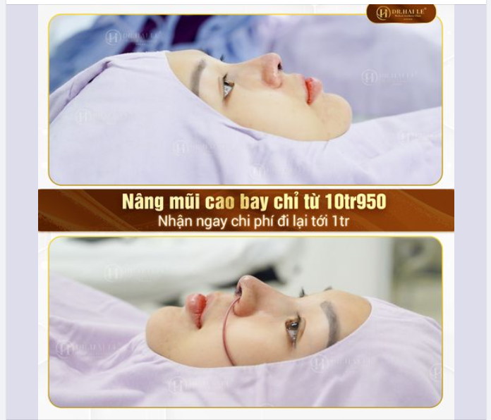 Cơ hội “tậu” mũi xinh với chi phí cực hợp lý và ngàn phần quà hấp dẫn đã đến với bạn rồi đây.