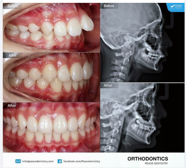 Ca lâm sàng chỉnh nha invisalign không nhổ răng cho trường hợp khớp cắn hạng II, cắn chìa vùng răng cửa, cắn sâu.