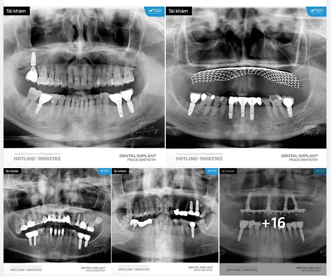 ALBUM TÁI KHÁM IMPLANT THÁNG 2/2024 - Part 2