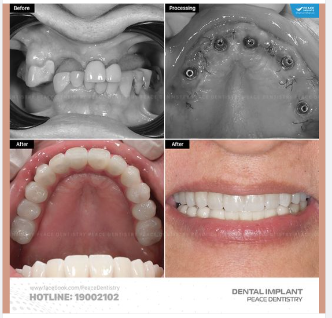 TRỒNG RĂNG IMPLANT là kỹ thuật được thực hiện độc lập và không xâm lấn, không ảnh hưởng đến răng kế cận.