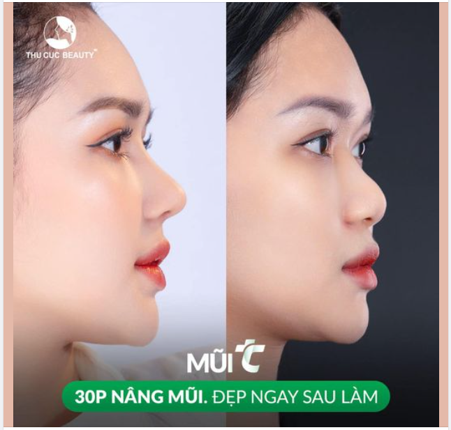 30 phút mũi thấp hóa cao sang đẹp ngay sau làm cho khách hàng