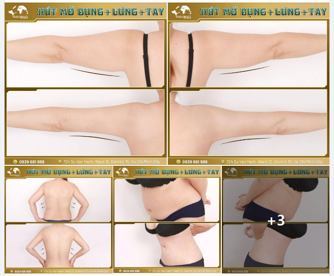 Siết gọn Body bằng combo hút mỡ chưa bao giờ dễ dàng và hiệu quả để mang lại kết quả thấy rõ như thế.